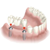 implantes